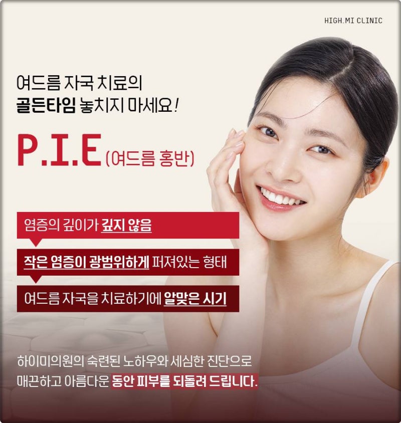 연산여드름흉터, 방치하지 말고 조기 치료가 답입니다
